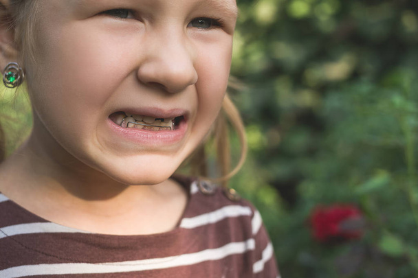 Kind mit kieferorthopädischem Gerät und ohne einen Zahn. - Foto, Bild
