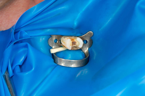 腐った歯の虫歯のクローズ アップの復元。歯科医院で治療の審美歯科のコンセプト - 写真・画像