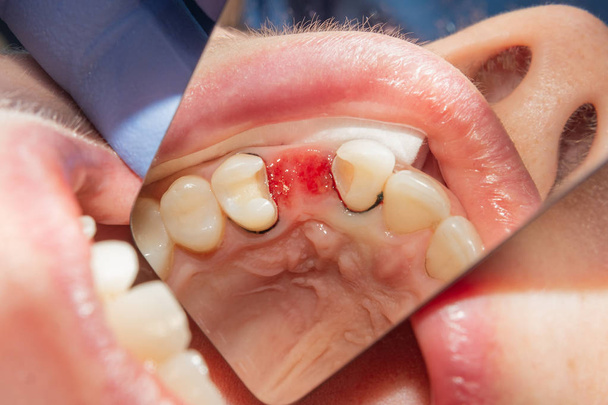 hampaiden palauttaminen endodonttisen hoidon jälkeen lasikuitutappeilla. Käsite esteettinen ortopedinen hammaslääketiede
 - Valokuva, kuva
