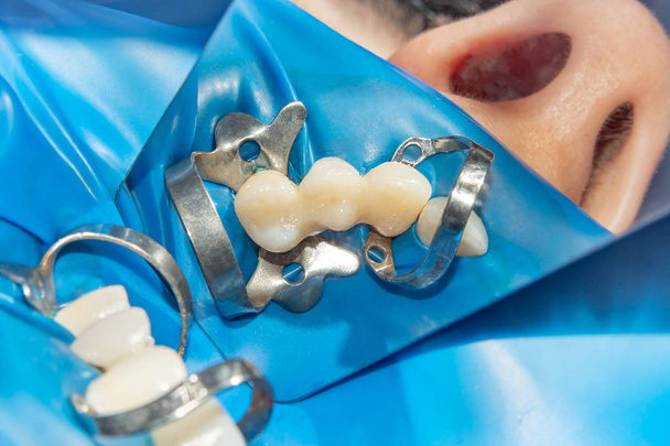 Wiederherstellung der Zähne nach endodontischer Behandlung mit Fiberglasstiften. das Konzept der ästhetischen orthopädischen Zahnheilkunde - Foto, Bild