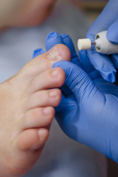 Podologiahoitoa. Jalkalääkäri kohtelee jalkaa. Jalkaterapia lääkäri tai ihotautilääkäri kohtelee
 - Valokuva, kuva