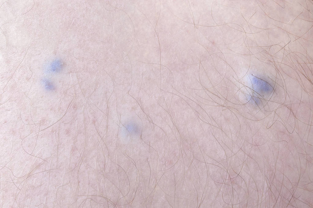 malattia della vena varicosa in un uomo, immagine da primo piano
 - Foto, immagini