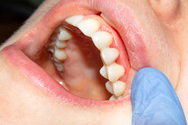 two chewing side teeth of the upper jaw after treatment of caries. Restoration of the chewing surface with a photopolymer filling material using the Rubber Dam system - Photo, Image