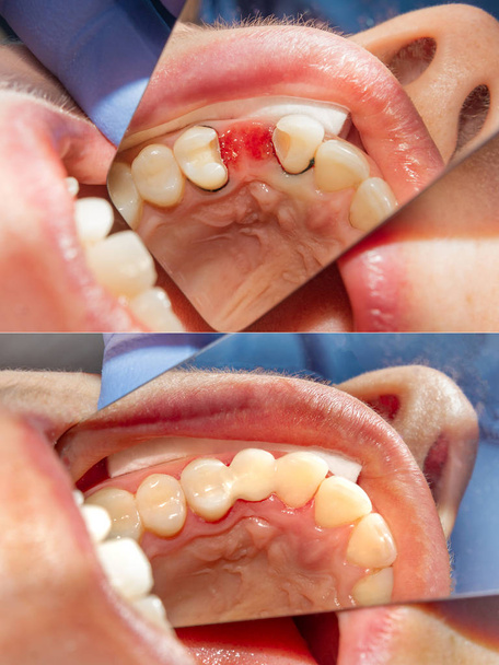 グラスファイバー フォトポリマー クローズ アップ再生材料を使用して歯にブリッジのインストール。整形外科の審美歯科医の概念 - 写真・画像