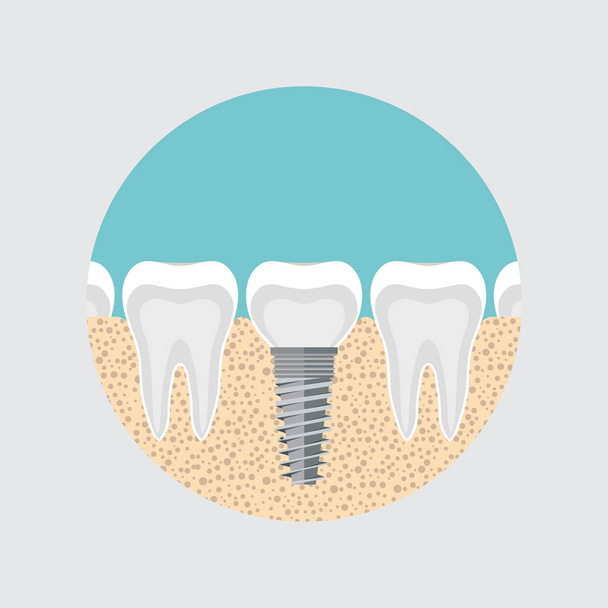 Implantat eines menschlichen Zahnes, Anatomie des Zahnkonzepts. Zahnwurzelkanal. Vektorbild der Zahnfarbe, flacher Stil der Zahnheilkunde, zahnmedizinisches Design, zahnärztliche Illustration, Malerei mit innovativer Technologie, die Zähne darstellt - Vektor, Bild