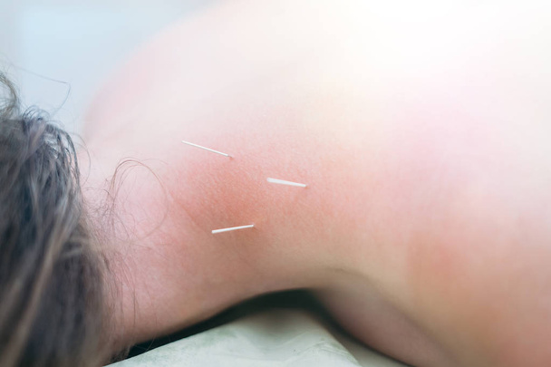 Fisioterapeuta fazendo acupuntura a uma jovem mulher de costas
 - Foto, Imagem