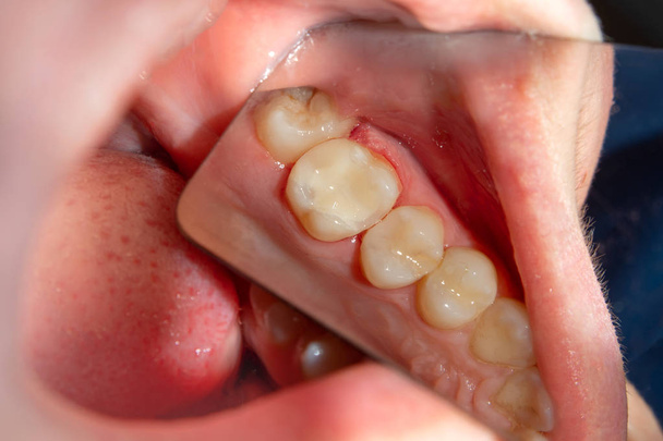 δύο μάσημα πλευρά τα δόντια της άνω γνάθου μετά από θεραπεία της τερηδόνας. Αποκατάσταση των μασητική επιφάνεια με ένα Φωτοπολυμερικές γεμίζοντας υλικού χρησιμοποιώντας το σύστημα ελαστικού απομονωτήρα - Φωτογραφία, εικόνα