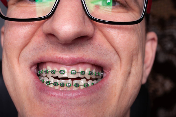 Portrait d'un homme avec des dents tordues et des bretelles métalliques avec des élastiques verts gros plan. Jeune homme avec orthèses dentaires
. - Photo, image