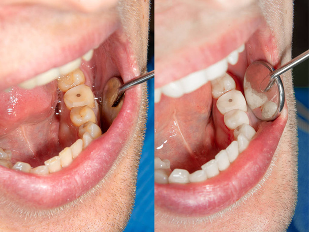 deux dents latérales à mâcher de la mâchoire supérieure après traitement des caries. Restauration de la surface à mâcher avec un matériau de remplissage photopolymère à l'aide du système de barrage en caoutchouc
 - Photo, image