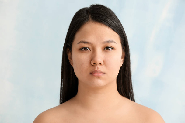Portrait of young Asian woman with acne problem on color background - Photo, Image