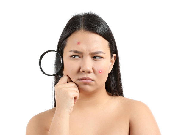 Retrato de mujer asiática joven con problema de acné y lupa sobre fondo blanco
 - Foto, imagen