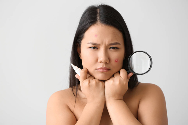 Retrato de mujer asiática joven con remedio para el acné y lupa sobre fondo blanco
 - Foto, Imagen