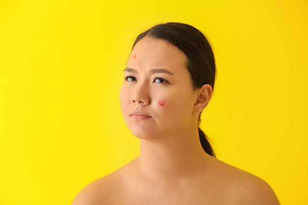 Retrato de mujer asiática joven con problema de acné en el fondo de color
 - Foto, Imagen