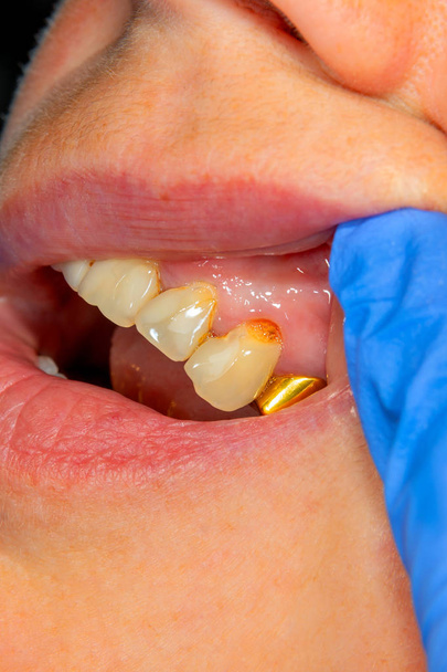 due denti laterali masticanti della mascella superiore dopo il trattamento della carie. Ripristino della superficie di masticazione con un materiale di riempimento fotopolimerico mediante il sistema Rubber Dam
 - Foto, immagini