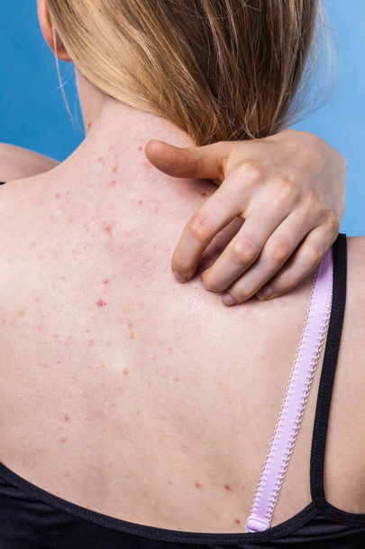 Health problem, skin diseases. Young woman showing her back with acne, red spots. Teen girl scratching her shoulder with pimples. - Zdjęcie, obraz