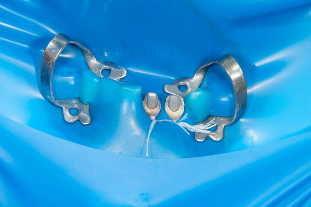 çürük kökleri ile seramik kron diş diş restorasyonu. Döküm diş hekimliği mesajları - Fotoğraf, Görsel