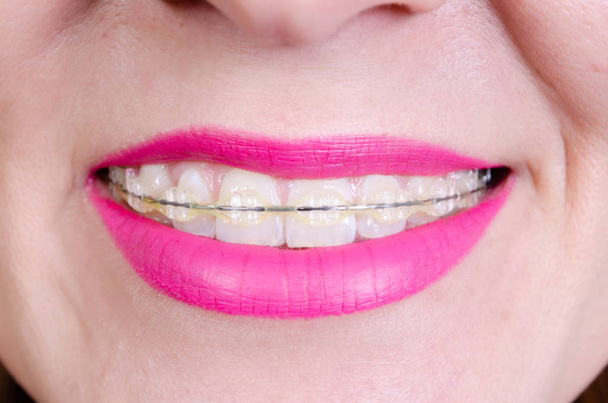 Teeth with sapphire braces and a smile of a young woman with painted lips. - Photo, Image