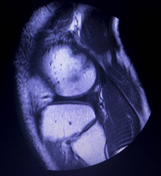 Resonancia magnética por resonancia magnética RMN de rodilla cuerno posterior menisco medial desgarro escasos resultados
. - Foto, Imagen