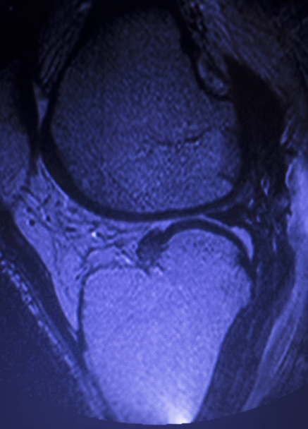 Magnetresonanztomographie mri knee posterior horn medial meniscus tear scantest results. - Foto, Bild