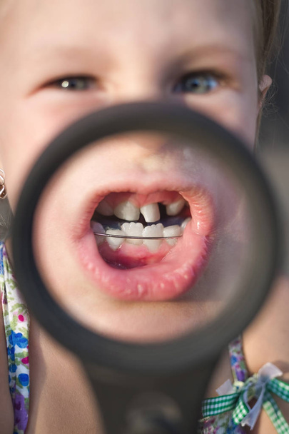 Маленькая девочка поднесла увеличительное стекло ко рту, чтобы показать ортодонтический прибор, кривые зубы и шаткий зуб
 - Фото, изображение
