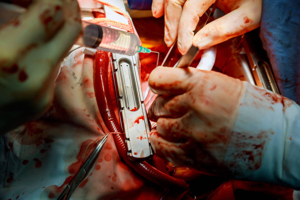 Ο χειρουργός κάνει μια χειρουργός στο χειρουργείο με αίμα λειτουργία. - Φωτογραφία, εικόνα
