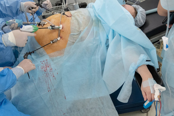 Endoscopia. Cirugía en el cuerpo de una mujer completa. Endovideocirugía. Las manos de los cirujanos con endoinstrumentos realizan una cirugía en el abdomen del paciente sobre una mesa quirúrgica en el hospital
. - Foto, imagen