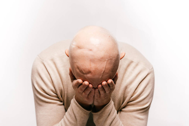 Bald man with psychological stress struggling for life after cancer neurosurgery operation - 写真・画像