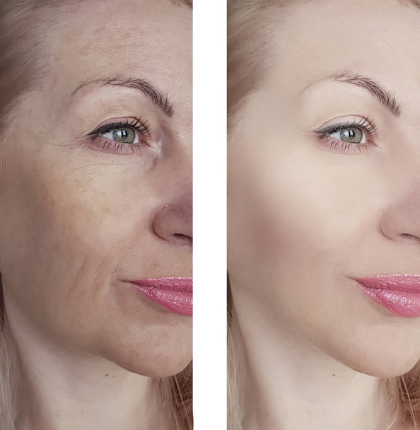 rugas da mulher antes e depois do procedimento
 - Foto, Imagem