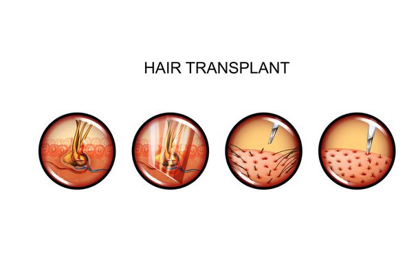 vector illustration of hair transplantation. head. alopecia - Vector, Image