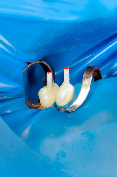 Caries dental. Relleno con material fotopolímero compuesto dental utilizando rabbders. El concepto de tratamiento dental en una clínica dental
 - Foto, Imagen