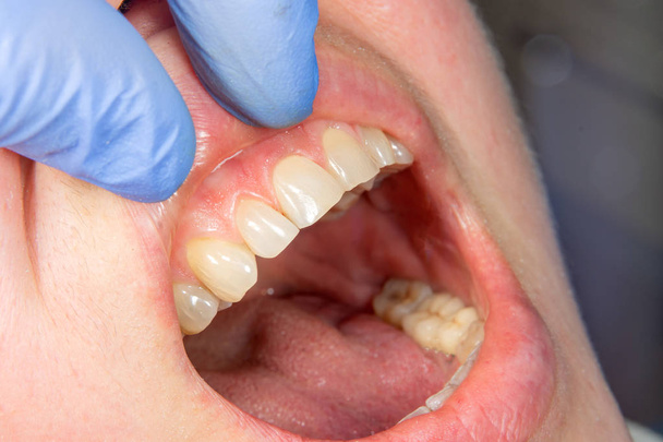 Zahnkaries. Füllung mit Dentalverbundphotopolymermaterial unter Verwendung von Kaninchen. Das Konzept der Zahnbehandlung in einer Zahnklinik - Foto, Bild