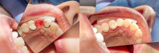 Füllung und Wiederherstellung von Zahnverlust mit Klebeverbundmaterial in Nahaufnahme. Konzept vor und nach zahnärztlicher Behandlung - Foto, Bild