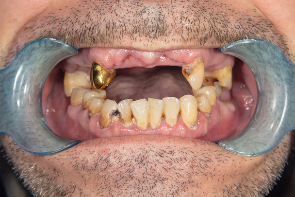 Verfaulte Zähne, Karies und Plaque in Großaufnahme bei einem asozialen Patienten. das Konzept der mangelhaften Hygiene und Gesundheitsprobleme - Foto, Bild
