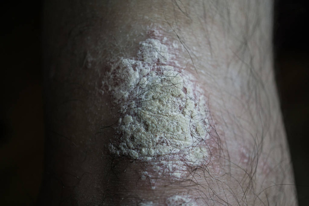 Psoriasis on knee of Caucasian man dermatological disease - Photo, Image