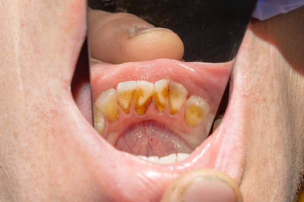 Verfaulte Zähne, Karies und Plaque nehmen einen asozial erkrankten Patienten aus nächster Nähe auf. das Konzept der mangelhaften Hygiene und Gesundheitsprobleme - Foto, Bild