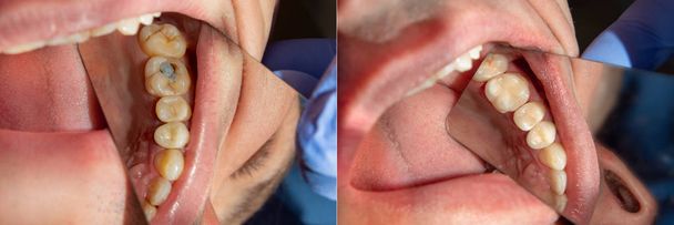 dva žvýkání postranních zubů horní čelisti po ošetření zubního kazu. Obnova povrchu žvýkací fotopolymerní výplňový materiál používá kofferdam systém - Fotografie, Obrázek