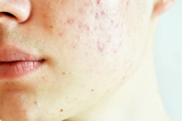 Nahaufnahme eines Mannes mit problematischer Haut und Akne-Narben - Foto, Bild