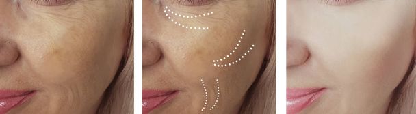 woman wrinkles before and after treatments - Photo, Image
