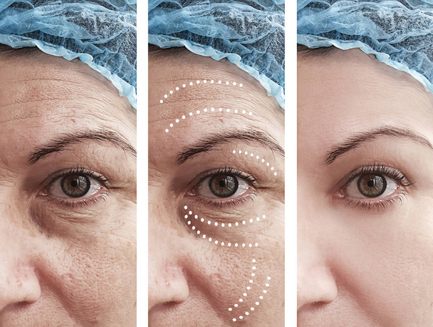 rugas da mulher antes e depois dos procedimentos
 - Foto, Imagem