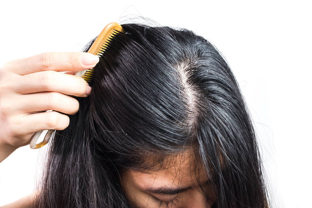 women head with dandruff Caused by the problem of dirty. Or caused by skin disease or Seborrheic Dermatitis. It has white scaly and it will cause itch. Product Concepts Scalp Care and Hair Care. - Photo, Image