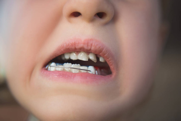Kuva pienen tytön suusta oikomishoidon laitteella ja vinoilla hampailla
 - Valokuva, kuva