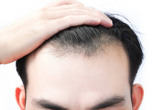 Young man serious hair loss problem for health care medical and shampoo product concept - Foto, afbeelding
