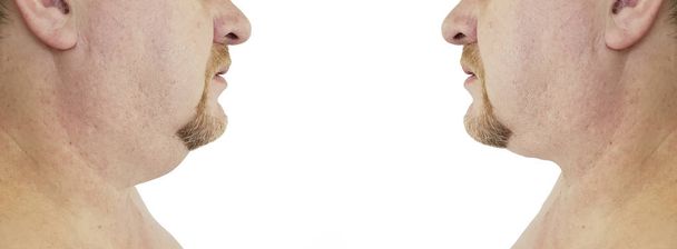 submental λίπους άνθρωπος πριν και μετά από διαδικασίες - Φωτογραφία, εικόνα