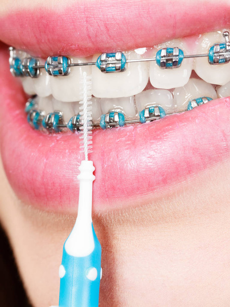 Dentist and orthodontist concept. Young woman cleaning and brushing teeth with blue braces using toothbrush - 写真・画像
