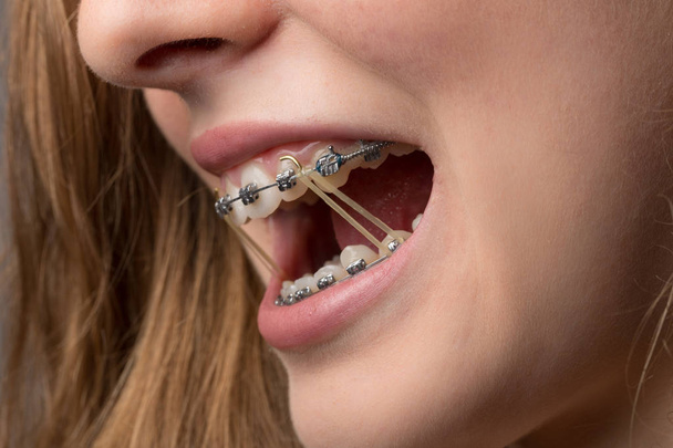 tizenévesek száját fogászati tartó és rögzítő gumi - Fotó, kép