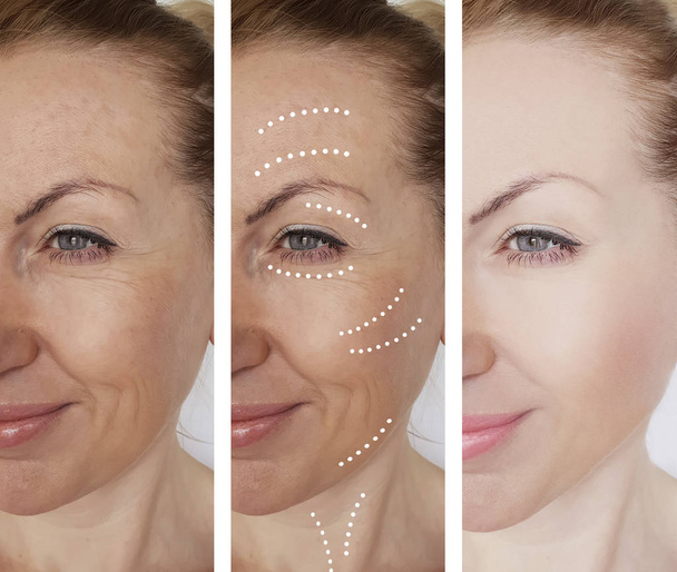 rugas da mulher antes e depois dos procedimentos
 - Foto, Imagem