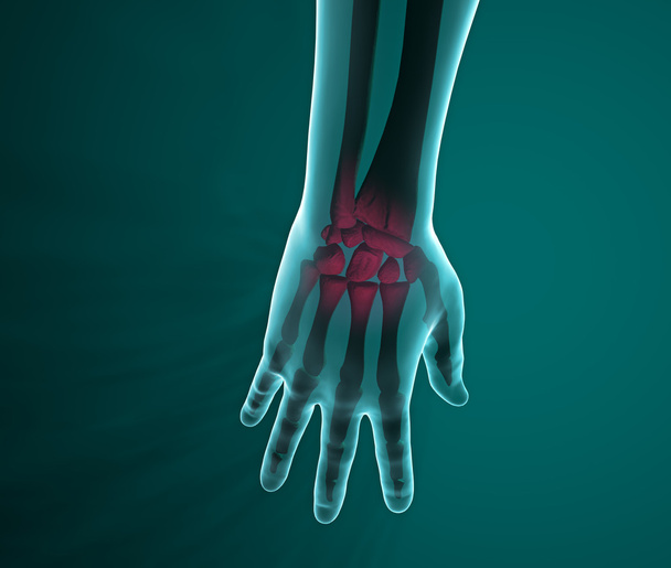 Рентген руки і зап'ястя біль
 - Фото, зображення