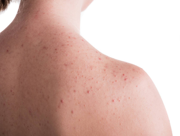 Concept de problème d'acné. Adolescente avec la peau problématique sur le dos posant sur un fond blanc
 - Photo, image