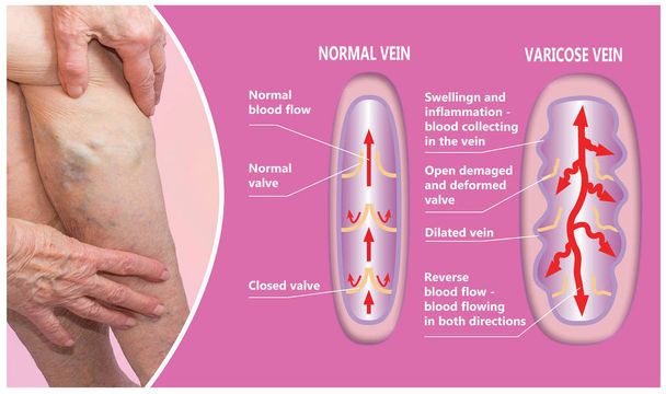Varices sur les jambes d'une femme âgée. La structure des veines normales et des varices. - Photo, image
