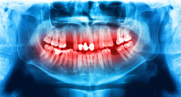 Dientes de rayos X azules y rojos escanean la mandíbula
. - Foto, imagen